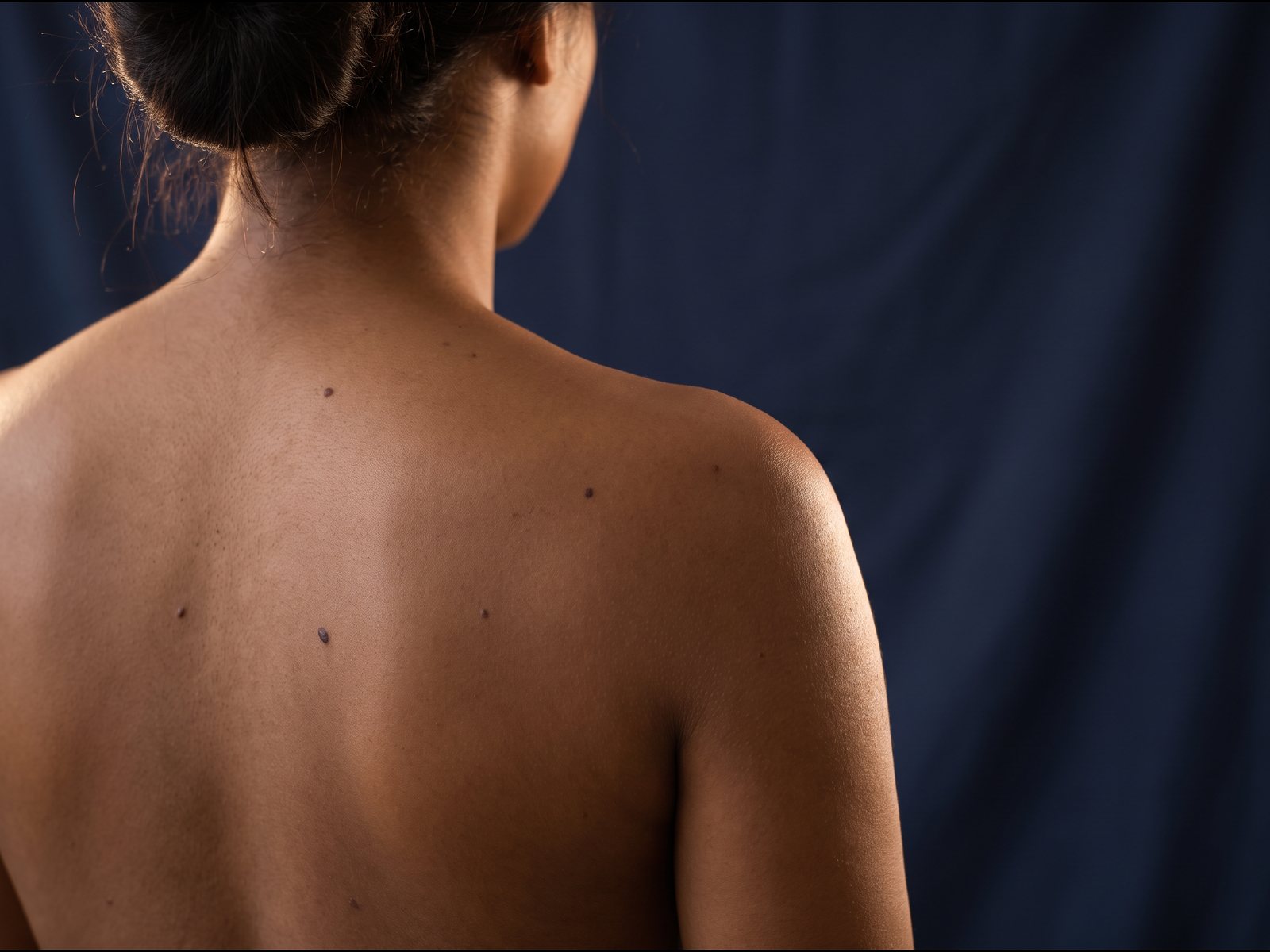 Clinical photograph of a woman's upper back and shoulder with several small moles, lit softly against navy